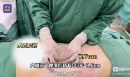 爆料桂哥抽脂视频大全图片,惊心动魄的瘦身之旅